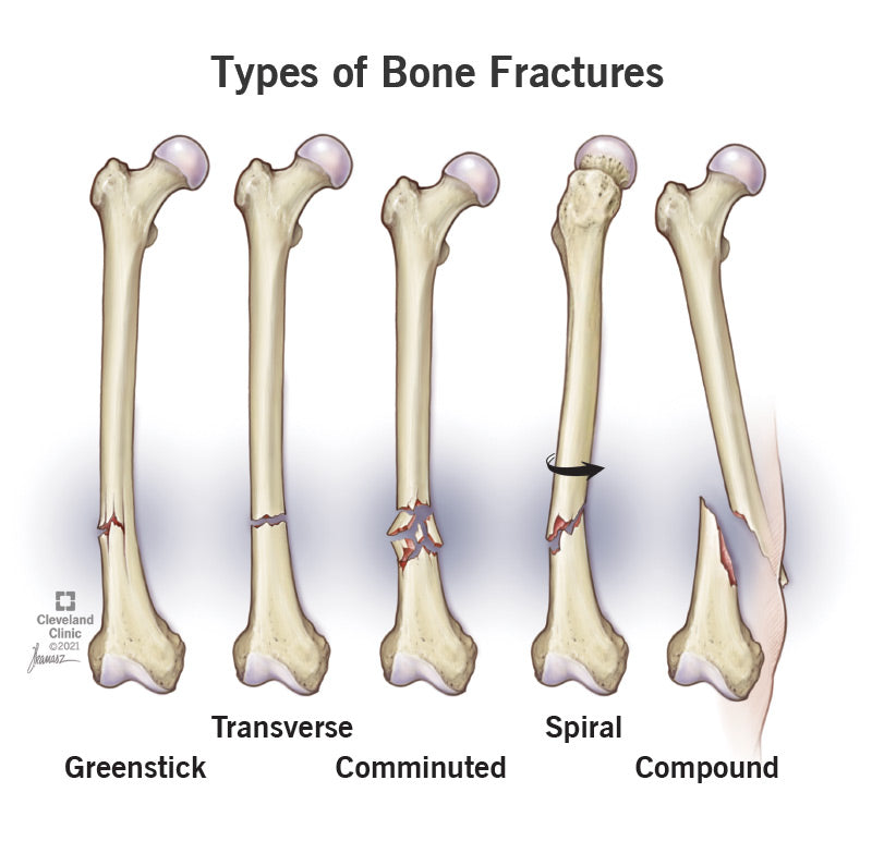 Understanding Bone Fractures: Types, Causes, Treatment, and Recovery ...