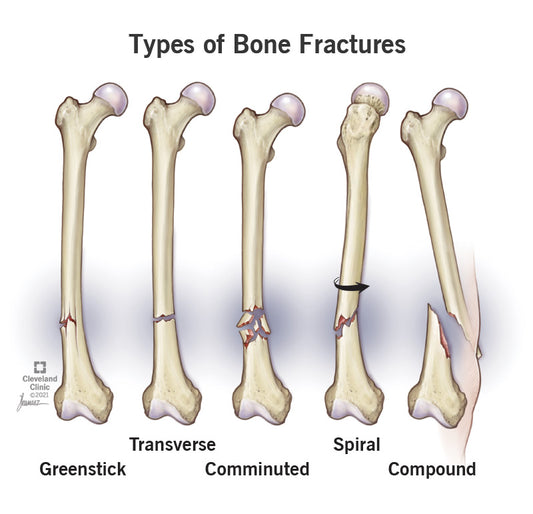 Understanding Bone Fractures: Types, Causes, Treatment, and Recovery