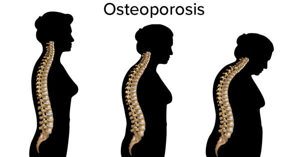 Understanding Osteoporosis: The Silent Thief of Bone Health