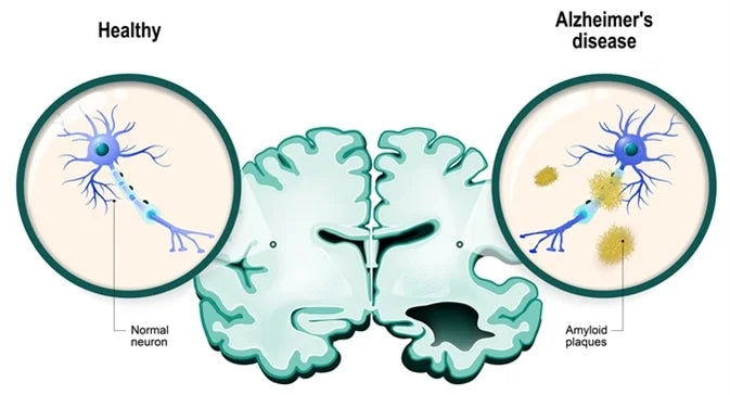 Navigating the Maze of Alzheimer's Disease: Understanding, Coping, and Supporting